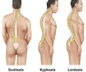 Diagram showing different abnormal spinal curvatures: scoliosis, kyphosis, and lordosis with labels.